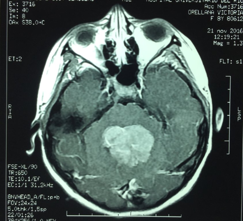 Meduloblastoma