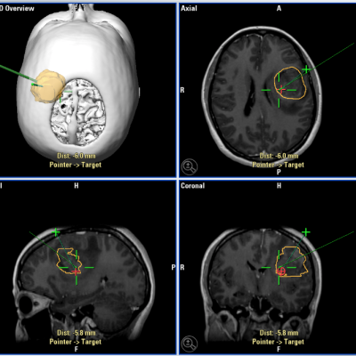 Glioma, Fluorescencia, Navegación y Neuroimagen avanzada