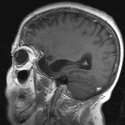 Meningioma