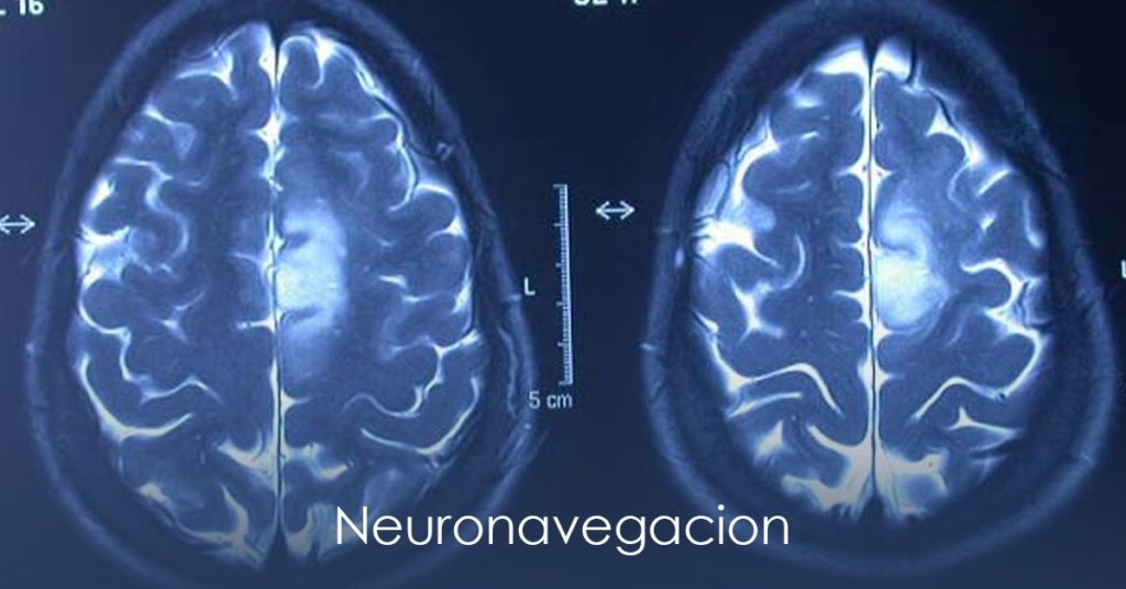 Neuronavegación