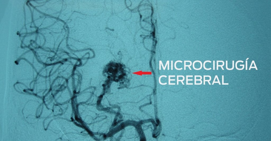Microcirugía cerebral