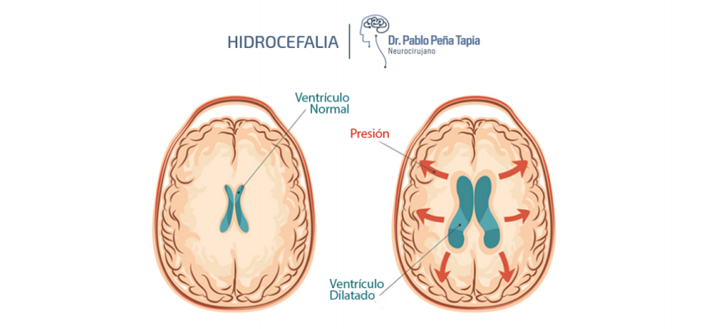 hidrocefalia